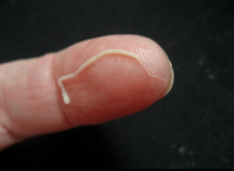 кръгъл червей паразит от човешкото тяло